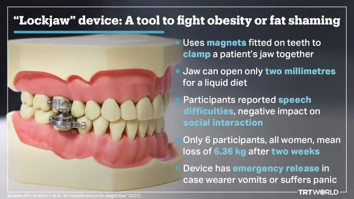 A device that locks the mouth and helps to lose weight has been invented
