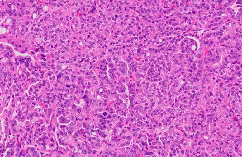 Histological Staining of a Lung Adenocarcinoma