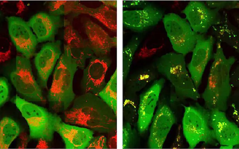 Parkinson’s, Cancer, and Type 2 Diabetes Share a Key Element That Drives Disease