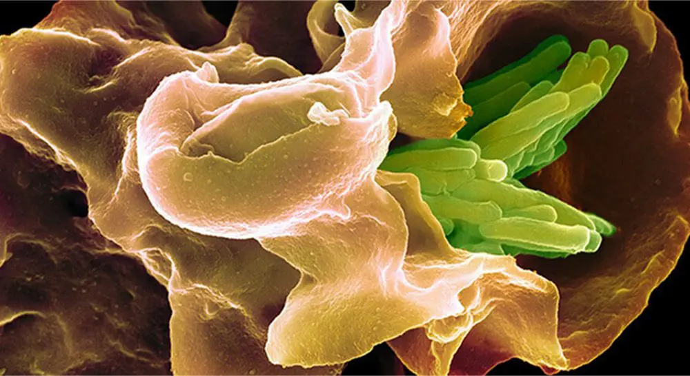 Tuberculosis remains one of the deadliest infectious diseases worldwide, warns new report