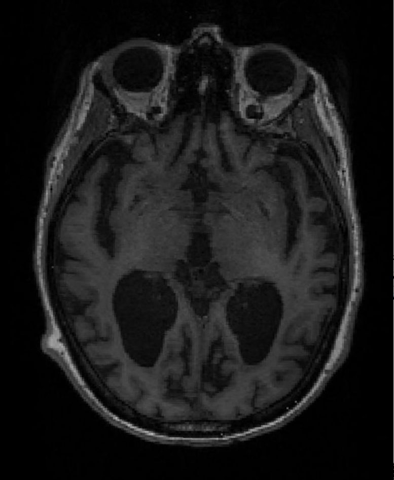 Alzheimer's Patient MRI Brain Scan