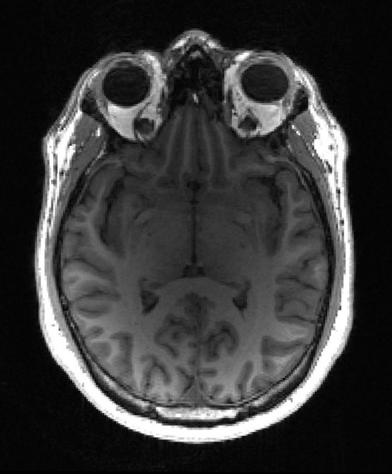 Healthy MRI Brain Scan