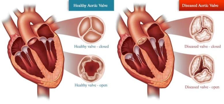 Болезнь аортального клапана сердца